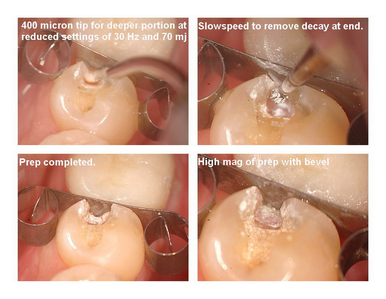 Amalgam removal 4_resize.jpg